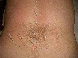 acupuntura lumbar x