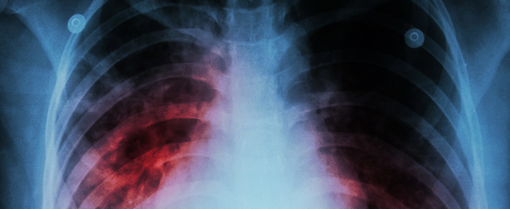 enfermedad pulmonar intersticial x