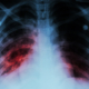enfermedad pulmonar intersticial x