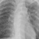 fibrosis pulmonar intersticial x