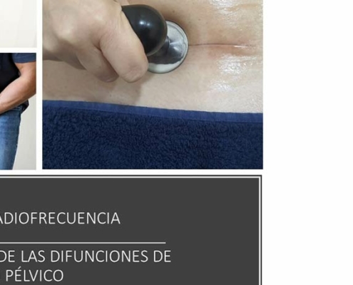 Diatermia radiofrecuencia en el tratamiento de las disfunciones de suelo pelvico Via Zoom  septiembre x